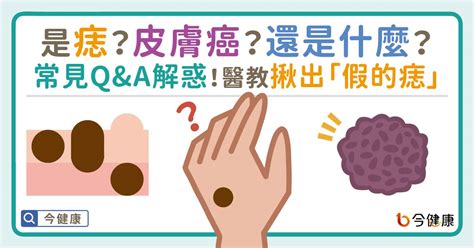 內痣是什麼|是痣？還是皮膚癌？皮膚科醫師教你揪出「假的痣」，。